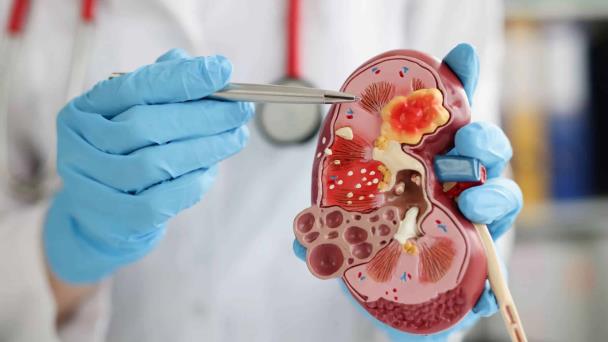 Enfermedad renal crónica padecimiento que afecta a cada vez más personas