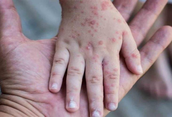 Advierte OPS de posible brote de sarampión y poliomielitis en México