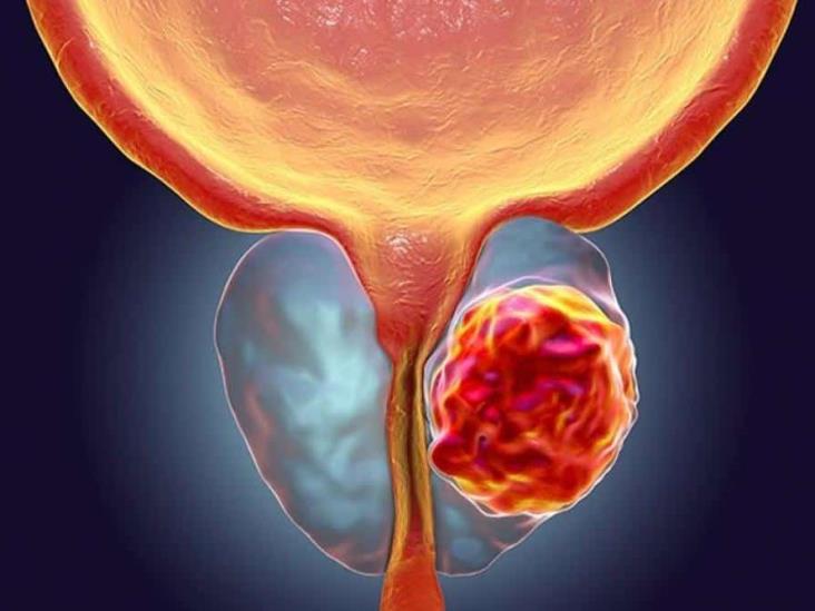 Por diagnóstico tardío, 70 % de casos de cáncer de próstata son incurables: experto