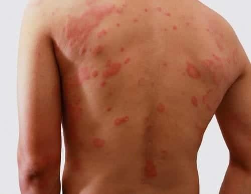 Veracruz, número uno en casos de dermatitis atópica
