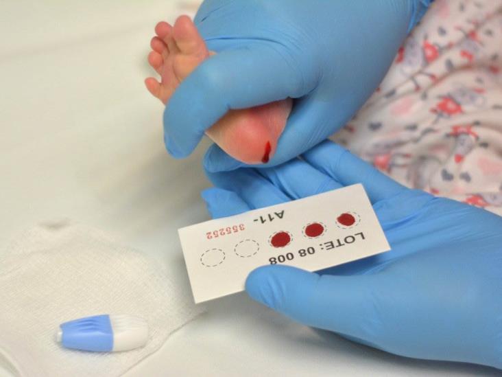 Tamiz neonatal, primordial para detección temprana de enfermedades raras