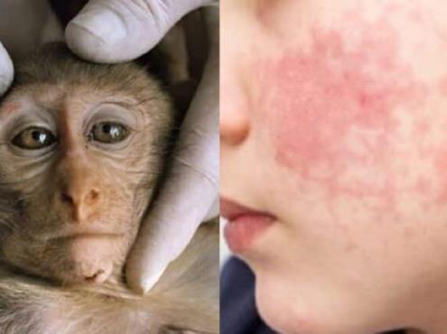 Alerta OMS sobre incremento de casos de la viruela del mono en el mundo, van 131