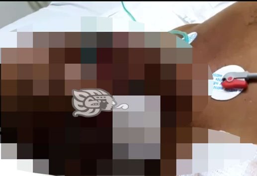 Atropellado en Minatitlán lucha por sobrevivir; culpable, ni sus luces

