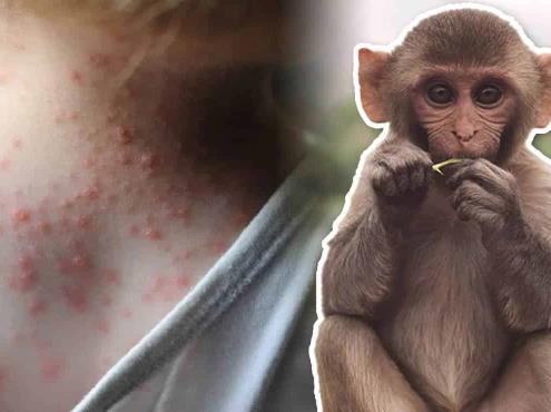 Seis casos de viruela del mono son investigados en Yucatán