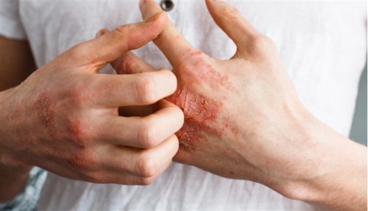 Conoce cómo afecta la psoriasis a la piel