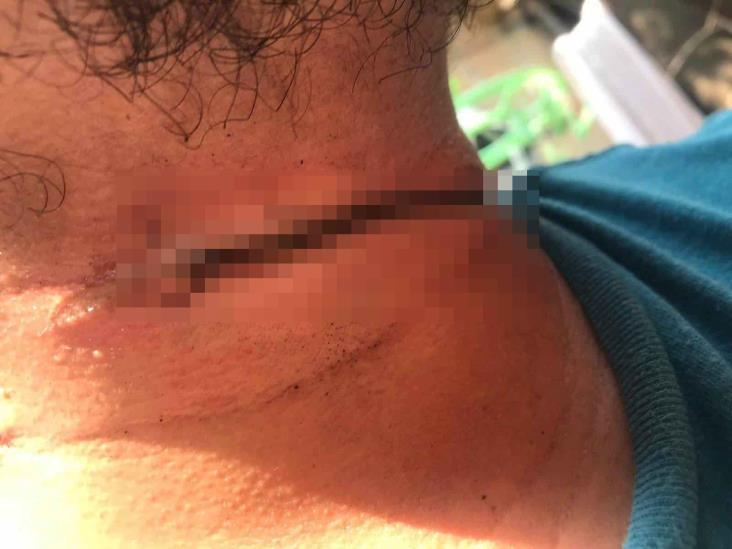 Motociclista, a nada de ser degollado por un cable suelto en Coatzacoalcos