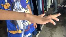 Adiel, de 11 años, no puede mover su mano; necesita ayuda para cirugías