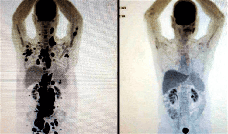 Paciente de cáncer curó sus tumores en solo un mes
