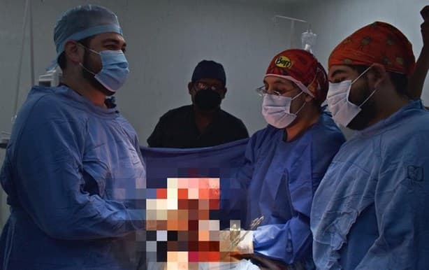 Extirpan tumor de 4 kilogramos en hospital IMSS-Bienestar de Chicontepec