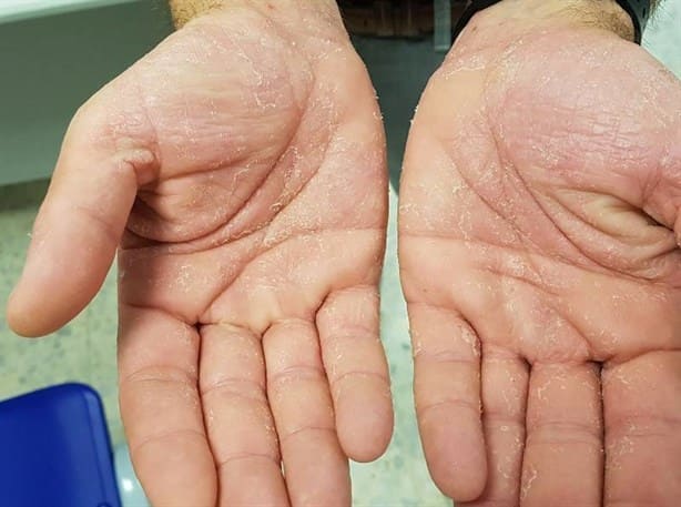 ¿Se te pelan las manos? Tu hígado puede estar funcionando mal