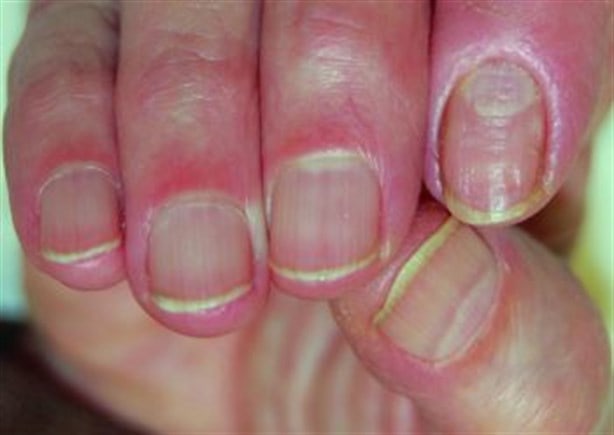 Alertan de infección provocada por morderte las uñas (+Video)