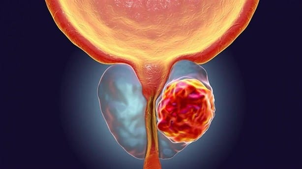 Cáncer de próstata: en Xalapa, hombres se niegan a realzarse exámenes