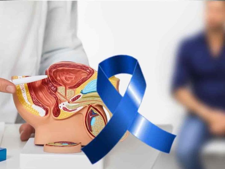 Cáncer de próstata: en Xalapa, hombres se niegan a realzarse exámenes