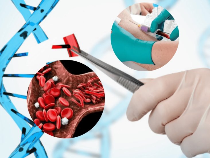 CRISPR: La esperanza para tratar la anemia falciforme y  talasemia
