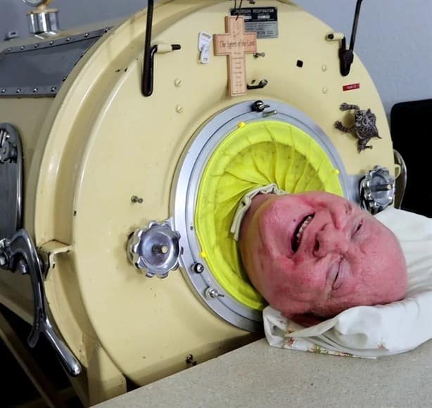 Conoce el pulmón de acero, el famoso aparato que mantuvo vivo a Paul Alexander por 72 años tras contraer polio