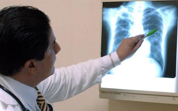 En marzo se conmemora el combate a la tuberculosis; estos son sus síntomas